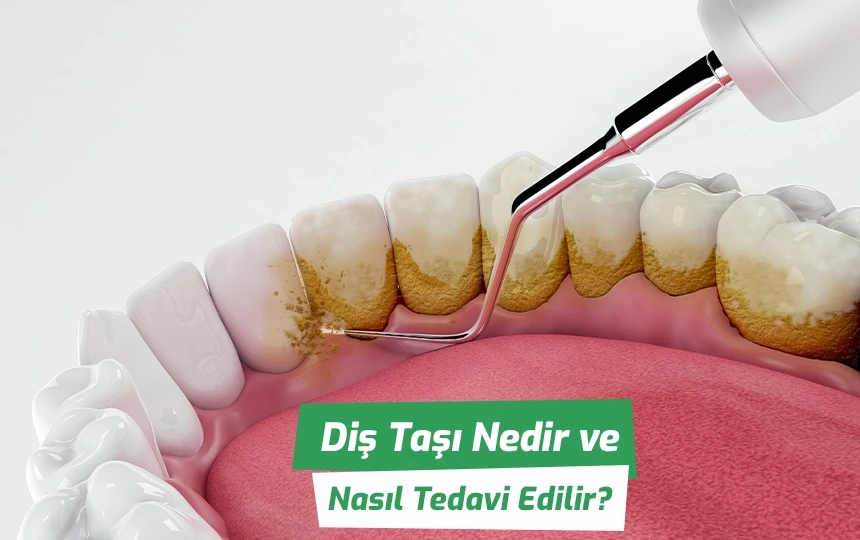 Diş taşı nedir ve nasıl tedavi edilir?
