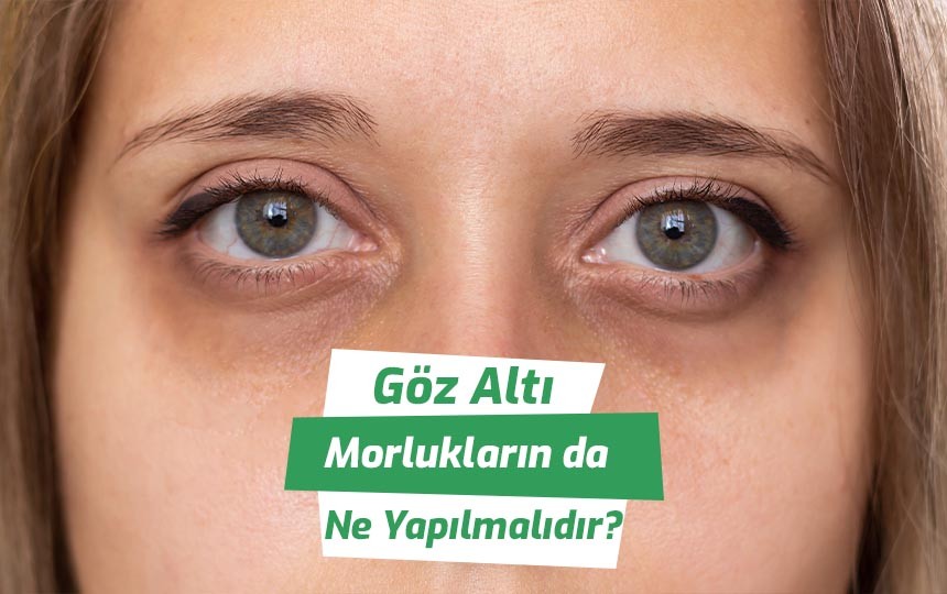 Göz altı morlukların da ne yapılmalıdır?