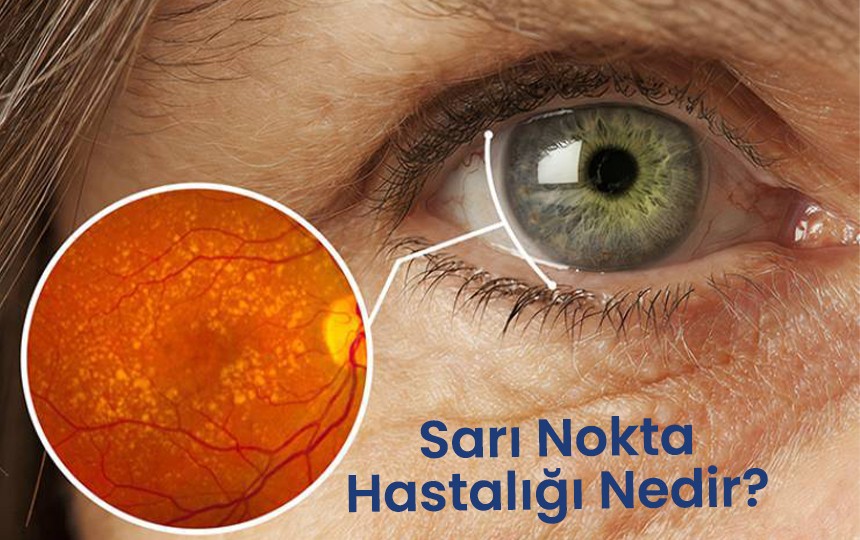 Sarı nokta hastalığı